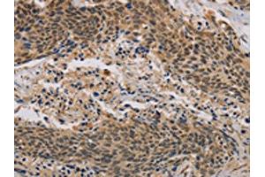 The image on the left is immunohistochemistry of paraffin-embedded Human cervical cancer tissue using ABIN7190296(CLEC5A Antibody) at dilution 1/20, on the right is treated with synthetic peptide. (CLEC5A anticorps)