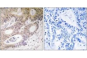 Immunohistochemistry analysis of paraffin-embedded human colon carcinoma tissue, using MSK1 (Ab-212) Antibody. (MSK1 anticorps  (AA 181-230))