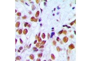 Immunohistochemical analysis of RAD54A staining in human breast cancer formalin fixed paraffin embedded tissue section. (RAD54L anticorps)