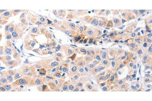Immunohistochemistry of paraffin-embedded Human lung cancer using CDK7 Polyclonal Antibody at dilution of 1:30 (CDK7 anticorps)