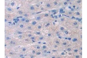 Detection of Pgp in Human Liver cancer Tissue using Polyclonal Antibody to Permeability Glycoprotein (Pgp)