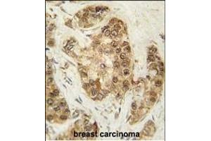 Formalin-fixed and paraffin-embedded human breast carcinoma tissue reacted with CDK2 Antibody (T14) (ABIN1881192 and ABIN2841623) , which was peroxidase-conjugated to the secondary antibody, followed by DAB staining.