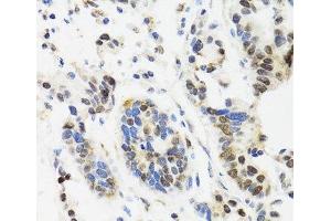 Immunohistochemistry of paraffin-embedded Human gastric cancer using TOP1 Polyclonal Antibody at dilution of 1:100 (40x lens). (Topoisomerase I anticorps)