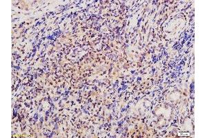 Formalin-fixed and paraffin embedded human nasopharyngeal carcinoma tissue labeled with Anti-Twist Polyclonal Antibody , Unconjugated at 1:200 followed by conjugation to the secondary antibody, (SP-0023), and DAB staining (TWIST1, TWIST2 (AA 71-170) anticorps)