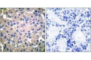 Immunohistochemistry analysis of paraffin-embedded human breast carcinoma tissue, using Transglutaminase 2 Antibody.