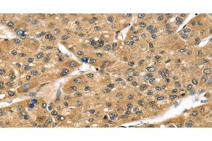 Immunohistochemistry of paraffin-embedded Human liver cancer tissue using STX8 Polyclonal Antibody at dilution 1:45 (STX8 anticorps)