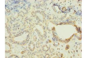 Immunohistochemistry of paraffin-embedded human breast cancer using ABIN7152421 at dilution of 1:100 (FBXO28 anticorps  (AA 251-368))