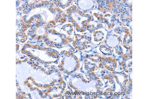 Immunohistochemistry of Human thyroid cancer using GJB3 Polyclonal Antibody at dilution of 1:30 (Connexin 31 anticorps)