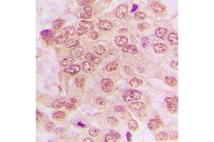 Immunohistochemical analysis of CDK2 staining in human lung cancer formalin fixed paraffin embedded tissue section.