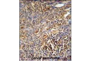 TANK Antibody (Center) (ABIN652041 and ABIN2840515) immunohistochemistry analysis in formalin fixed and paraffin embedded human cervix carcinoma followed by peroxidase conjugation of the secondary antibody and DAB staining.