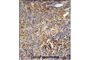 TANK Antibody (Center) (ABIN652041 and ABIN2840515) immunohistochemistry analysis in formalin fixed and paraffin embedded human cervix carcinoma followed by peroxidase conjugation of the secondary antibody and DAB staining. (TANK anticorps  (AA 88-114))