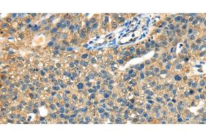 Immunohistochemistry of paraffin-embedded Human breast cancer tissue using DHCR24 Polyclonal Antibody at dilution 1:40 (Seladin 1 anticorps)
