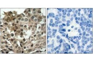 Immunohistochemistry analysis of paraffin-embedded human breast carcinoma tissue, using FKHRL1 (Ab-253) Antibody. (FOXO3 anticorps  (AA 220-269))