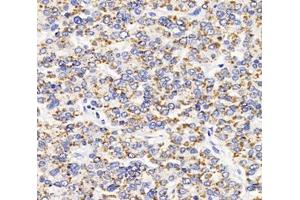 Immunohistochemistry analysis of paraffin-embedded human liver cancer using AGXT (ABIN7072987) at dilution of 1: 2000
