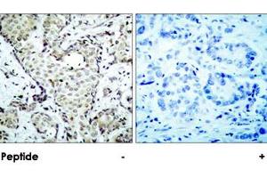 Immunohistochemical analysis of paraffin-embedded human breast carcinoma tissue using MAP2K6 polyclonal antibody . (MAP2K6 anticorps  (Ser207))