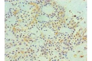 Immunohistochemistry of paraffin-embedded human breast cancer using ABIN7159251 at dilution of 1:100