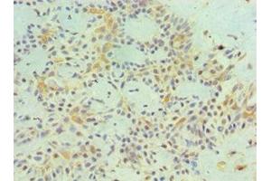 Immunohistochemistry of paraffin-embedded human breast cancer using ABIN7159251 at dilution of 1:100 (MAGEA1 anticorps  (AA 1-309))