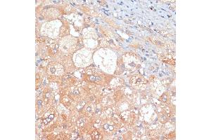 Immunohistochemistry of paraffin-embedded human liver cancer using RIPK3 antibody (ABIN6132598, ABIN6146964, ABIN6146967 and ABIN6221084) at dilution of 1:100 (40x lens). (RIPK3 anticorps  (AA 1-120))