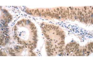 Immunohistochemistry of paraffin-embedded Human colon cancer tissue using RAD52 Polyclonal Antibody at dilution 1:50 (RAD52 anticorps)