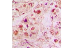 Immunohistochemical analysis of p53 staining in human lung cancer formalin fixed paraffin embedded tissue section. (p53 anticorps  (C-Term))