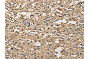 The image on the left is immunohistochemistry of paraffin-embedded Human thyroid cancer tissue using ABIN7128351(ALDH8A1 Antibody) at dilution 1/30, on the right is treated with fusion protein. (ALDH8A1 anticorps)
