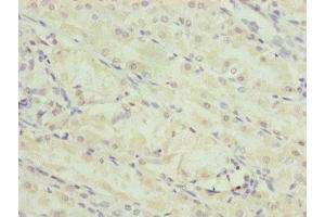 Immunohistochemistry of paraffin-embedded human gastric cancer using ABIN7151252 at dilution of 1:100