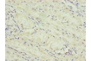 Immunohistochemistry of paraffin-embedded human gastric cancer using ABIN7151252 at dilution of 1:100 (TRIM23 anticorps  (AA 1-280))