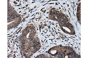 Immunohistochemical staining of paraffin-embedded Adenocarcinoma of colon tissue using anti-MTRF1L mouse monoclonal antibody. (MTRF1L anticorps)