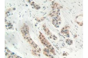 IHC-P analysis of Human Breast cancer Tissue, with DAB staining. (HMGB1 anticorps  (AA 1-215))