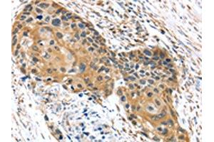 The image on the left is immunohistochemistry of paraffin-embedded Human esophagus cancer tissue using ABIN7192977(UBTD1 Antibody) at dilution 1/30, on the right is treated with synthetic peptide. (UBTD1 anticorps)