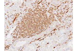 IHC-P Image Immunohistochemical analysis of paraffin-embedded human gastric cancer, using alpha Actin (cardiac muscle), antibody at 1:100 dilution. (ACTC1 anticorps)