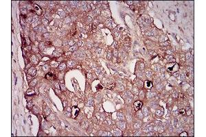 Immunohistochemical analysis of paraffin-embedded esophagus cancer tissues using NT5E mouse mAb with DAB staining.