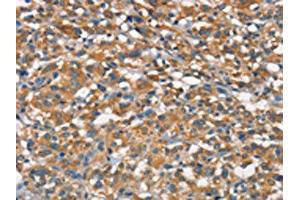 The image on the left is immunohistochemistry of paraffin-embedded Human thyroid cancer tissue using ABIN7189845(APOA1BP Antibody) at dilution 1/15, on the right is treated with synthetic peptide. (APOA1BP anticorps)