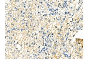 Phospho-Beclin 1 (Ser295) Antibody at 1/100 staining Human kidney cancer by IHC-P.