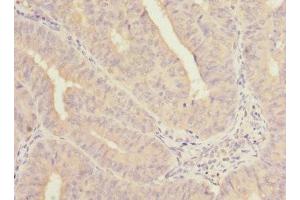 Immunohistochemistry of paraffin-embedded human endometrial cancer using ABIN7161139 at dilution of 1:100 (COBRA1 anticorps  (AA 8-199))