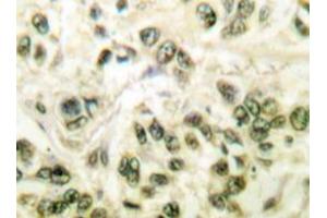 Immunohistochemistry analyzes of SMAP45 antibody in paraffin-embedded human breast carcinoma tissue. (HDAC3 anticorps)