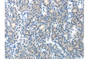 The image on the left is immunohistochemistry of paraffin-embedded Human thyroid cancer tissue using ABIN7128892(CEACAM1 Antibody) at dilution 1/25, on the right is treated with fusion protein. (CEACAM1 anticorps)