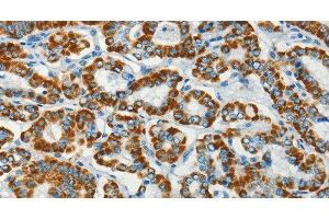 Immunohistochemistry of paraffin-embedded Human thyroid cancer using BCAT2 Polyclonal Antibody at dilution of 1:70 (BCAT2 anticorps)