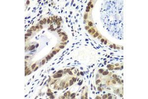 Immunohistochemistry of paraffin-embedded human gastric cancer using RNF2 antibody. (RNF2 anticorps  (AA 1-336))