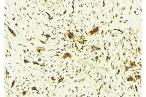 ABIN6269246 at 1/100 staining Human breast cancer tissue by IHC-P. (STAT6 anticorps  (Internal Region))