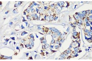 Immunohistochemistry of paraffin-embedded Human breast cancer using KMT2E Polyclonal Antibody at dilution of 1:200 (40x lens). (MLL5/KMT2E anticorps)