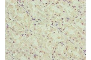 Immunohistochemistry of paraffin-embedded human gastric cancer using ABIN7151202 at dilution of 1:100