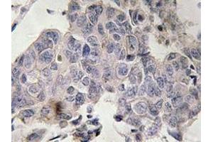 Immunohistochemistry analyzes of STAM2 antibody in paraffin-embedded human lung carcinoma tissue. (STAM2 anticorps)