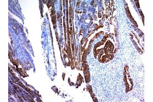 Formalin-fixed, paraffin-embedded human Colon Carcinoma stained with MUC2 Mouse Monoclonal Antibody (MLP/842).