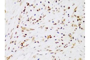 Immunohistochemistry of paraffin-embedded human liver cancer using IKKβ antibody (ABIN3022875, ABIN3022876, ABIN3022877 and ABIN6219275) at dilution of 1:100 (40x lens).