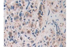 Detection of CFL1 in Human Prostate cancer Tissue using Polyclonal Antibody to Cofilin 1 (CFL1)