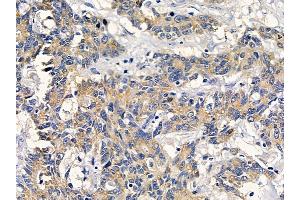 ABIN6261841 and ABIN6278571 at 1/100 staining human colorectal cancer by IHC-P.