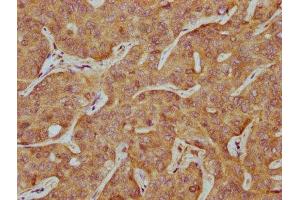 IHC image of ABIN7170299 diluted at 1:500 and staining in paraffin-embedded human liver cancer performed on a Leica BondTM system.