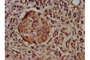 IHC image of ABIN7174451 diluted at 1:500 and staining in paraffin-embedded human pancreatic cancer performed on a Leica BondTM system.