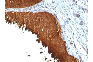 Formalin-fixed, paraffin-embedded human Bladder Carcinoma stained with Cytokeratin 19 Monoclonal Antibody (KRT19/799 + KRT19/800) (Cytokeratin 19 anticorps)